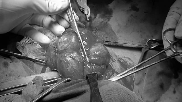 Cụ bà phải ngủ ngồi gần 2 năm vì mang khối bướu to ảnh 1