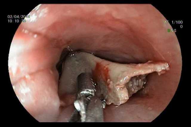 Vừa ăn vừa xem tivi, bé gái phải nhập viện cấp cứu ảnh 1
