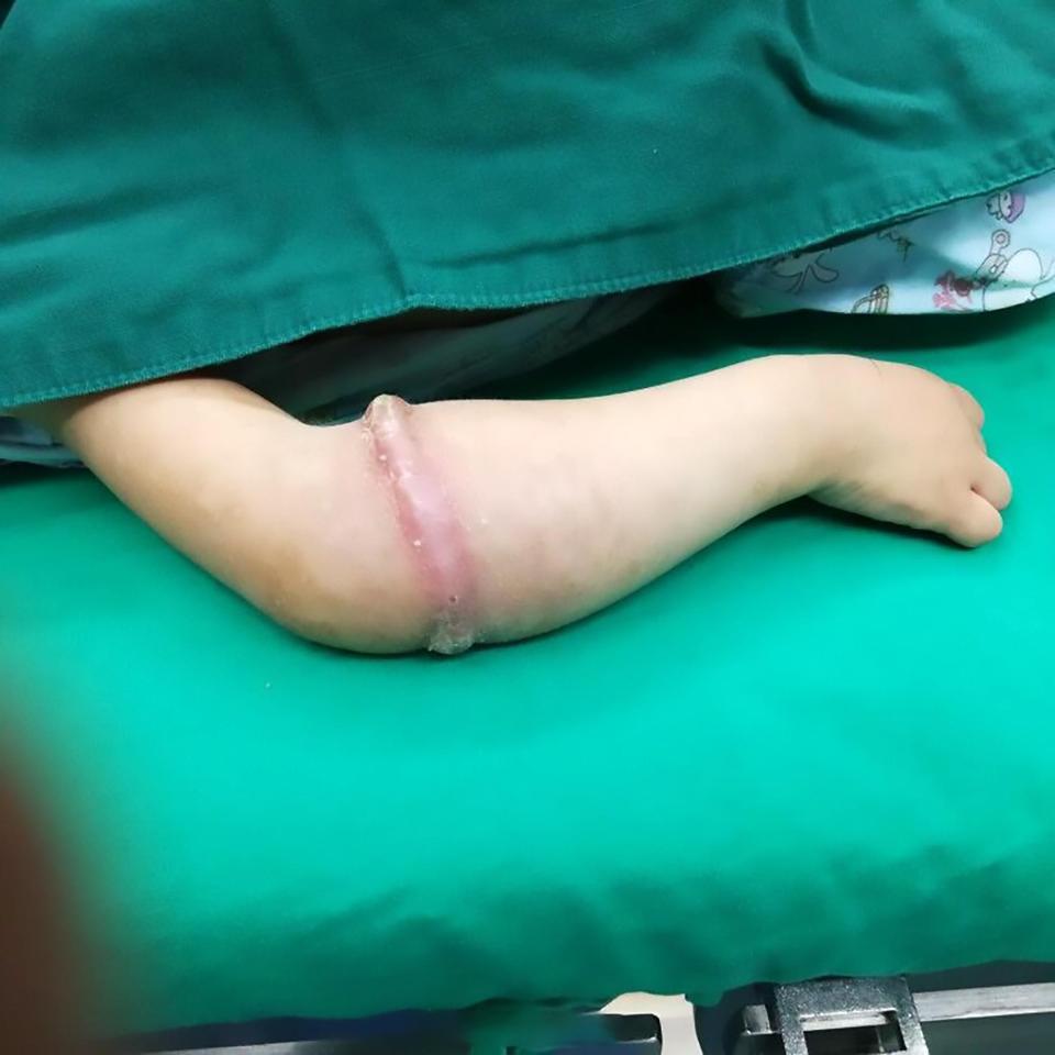 Dây chun đeo quá lâu ăn sâu vào thịt bé gái ảnh 1