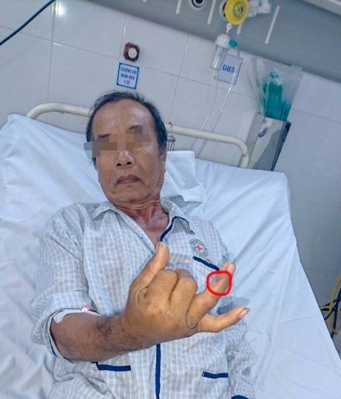 TP Hồ Chí Minh nhiều trường hợp bị rắn lục đuôi đỏ cắn ảnh 1