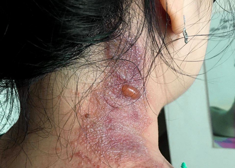 Viêm da do tiếp xúc kiến ba khoang nhưng bị chẩn đoán nhầm sang bệnh Zona thần kinh