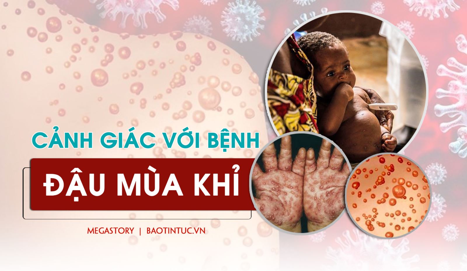 Cảnh giác với bệnh đậu mùa khỉ