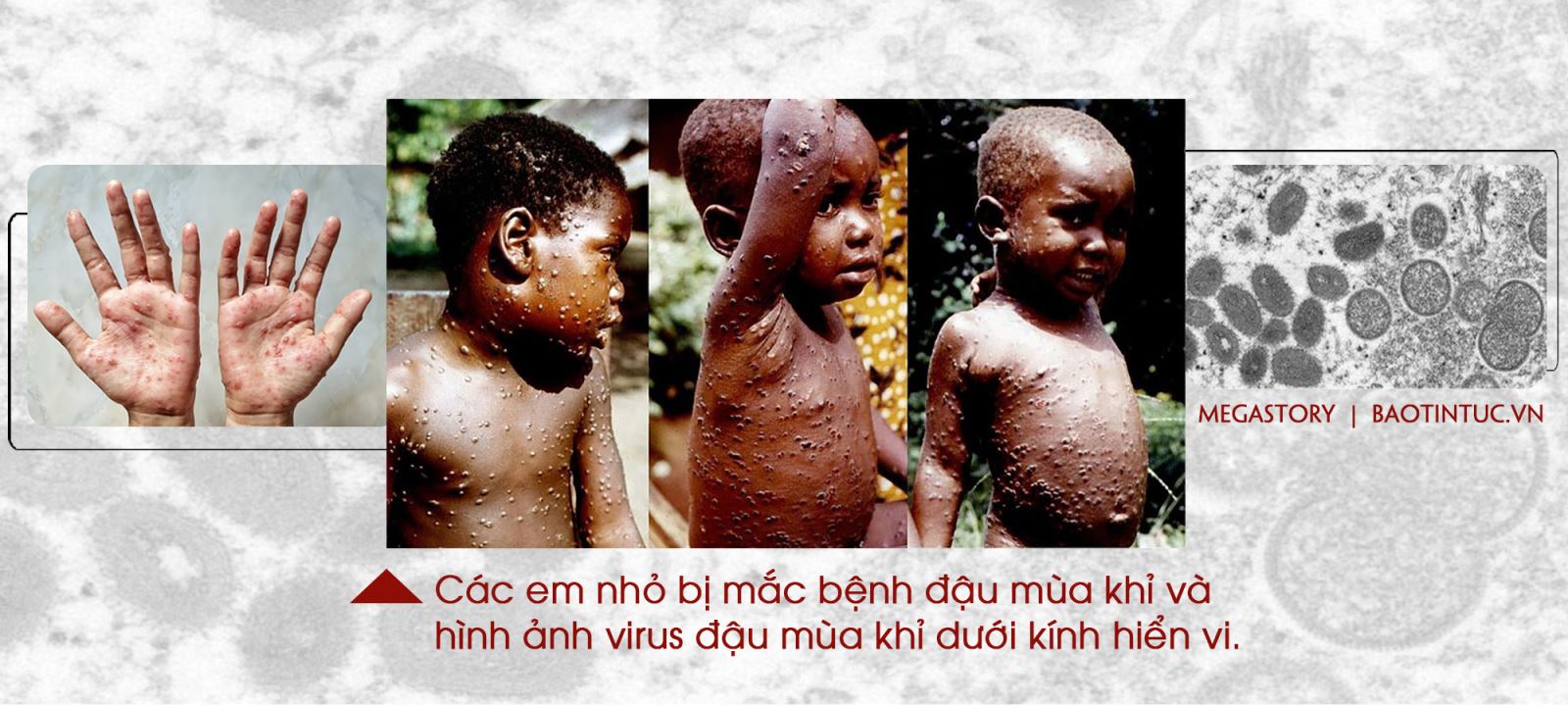 Cảnh giác với bệnh đậu mùa khỉ ảnh 3