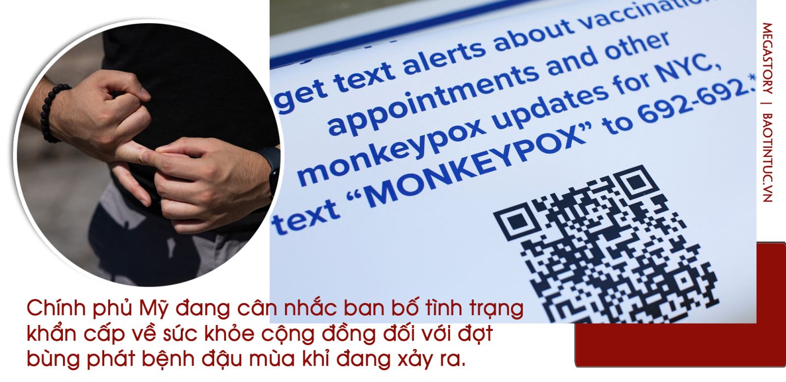 Cảnh giác với bệnh đậu mùa khỉ ảnh 9