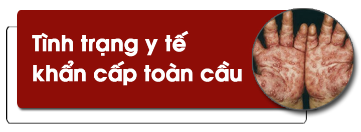 Cảnh giác với bệnh đậu mùa khỉ ảnh 1
